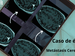 radiocirugía en metástasis cerebrales