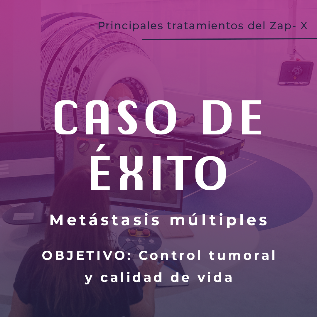 Radiocirugía en metástasis cerebrales